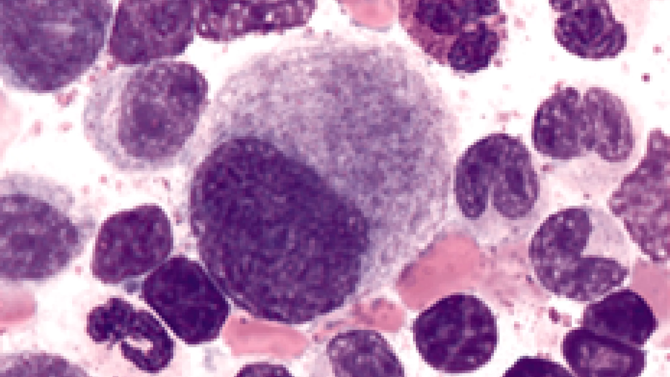 Leukemia
