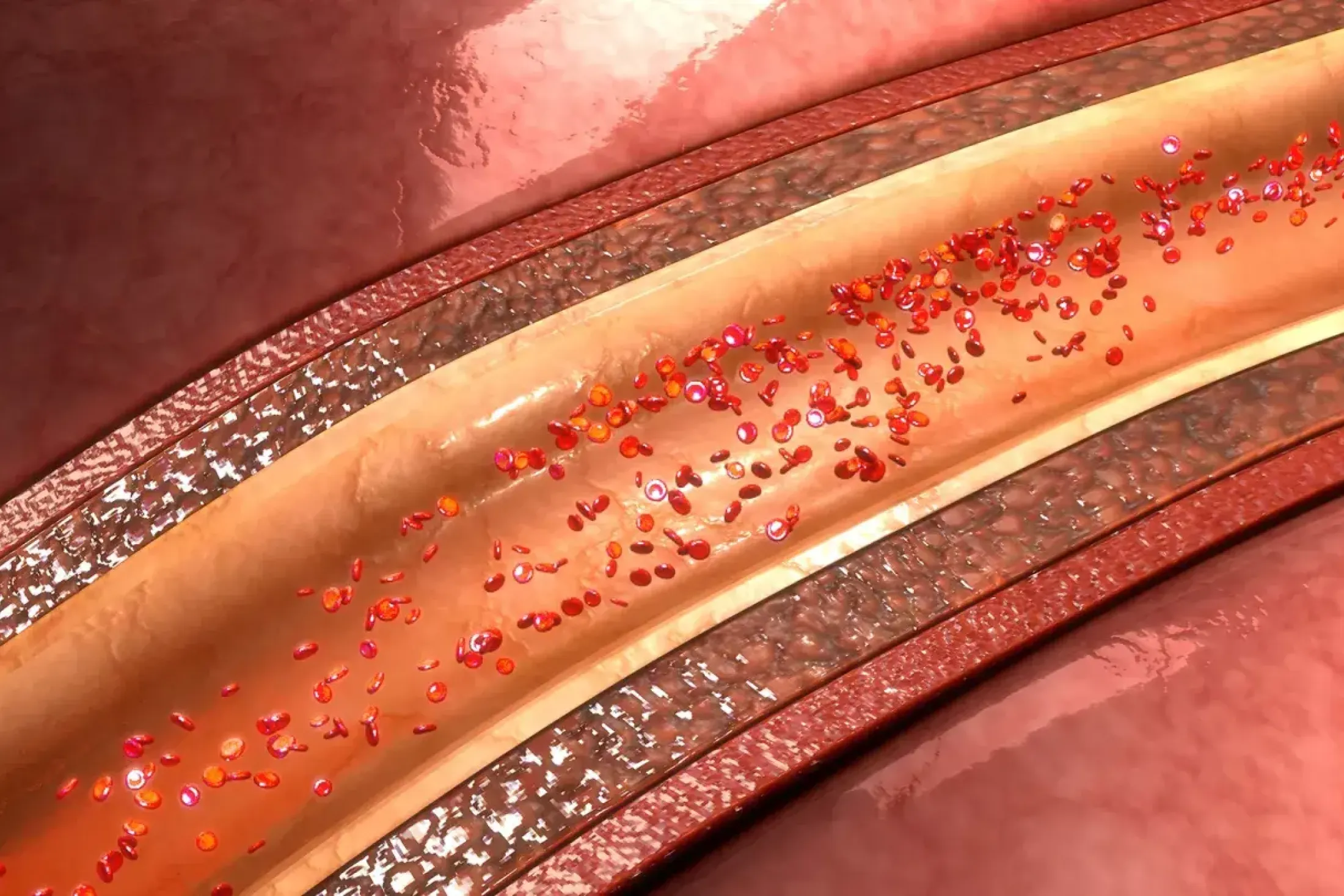 Wei Chen Investigating arterial Calcium bildup in Chronic Kidney Disease
