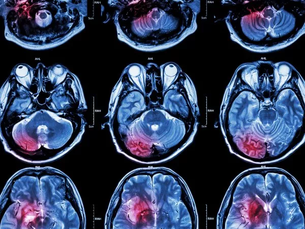 cancer-and-cancer-therapy