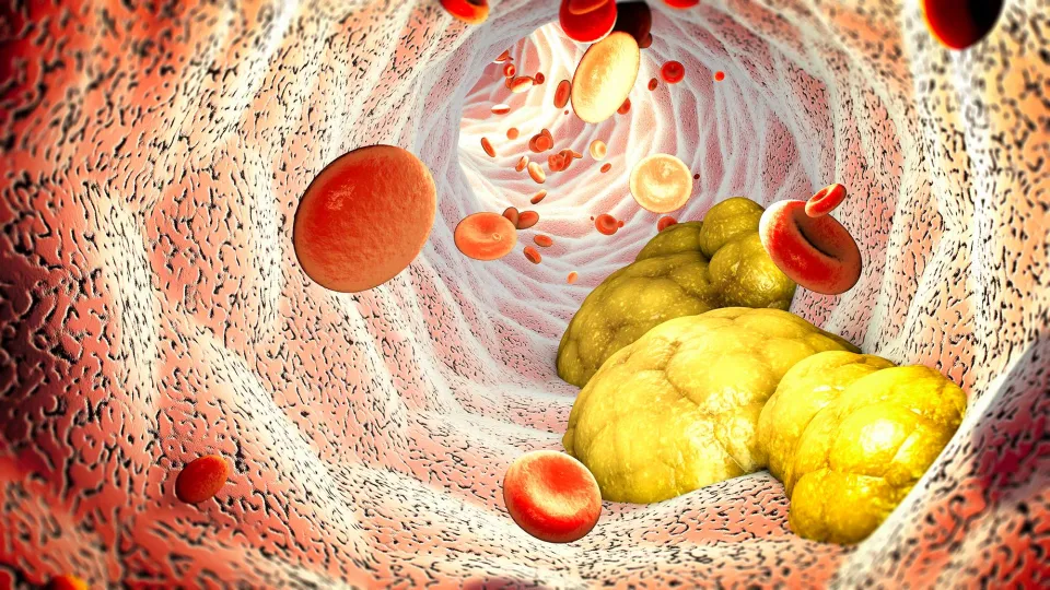 Low “Bad” Cholesterol Increases Bleeding Risk for Aspirin Takers