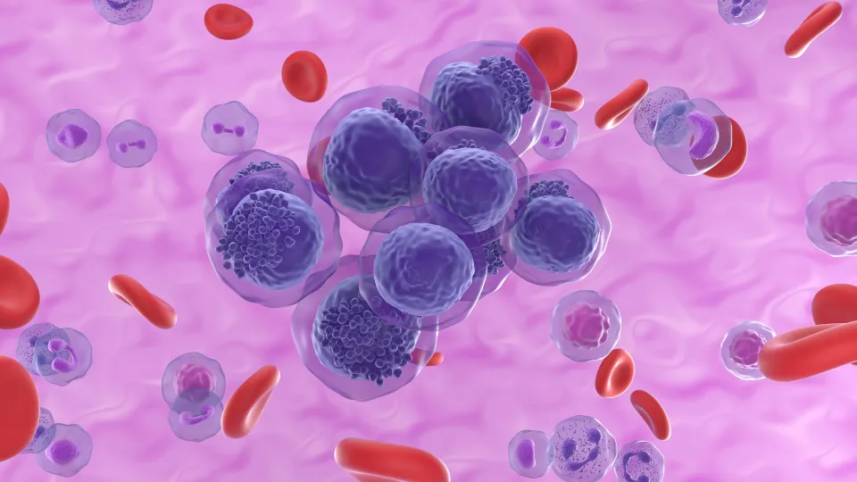 Acute myeloid leukemia, illustration