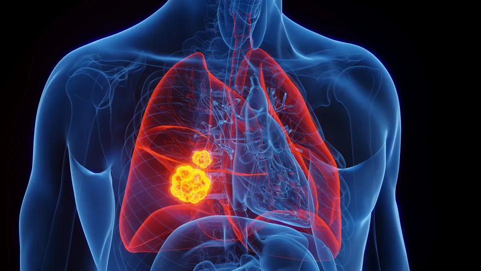 Lung Cancer Illustration