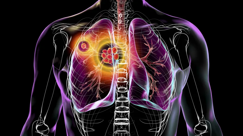 Testing a Novel Tuberculosis Treatment Approach